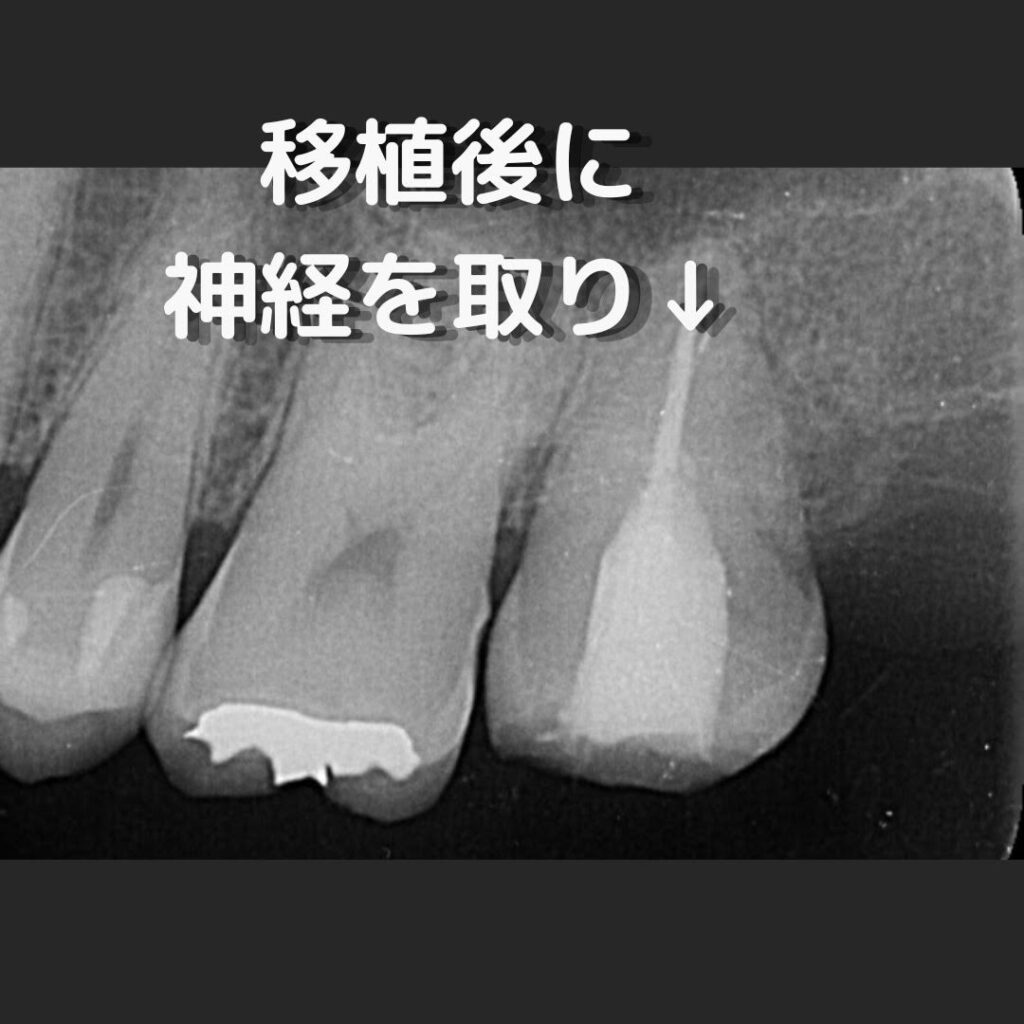 歯周外科症例③