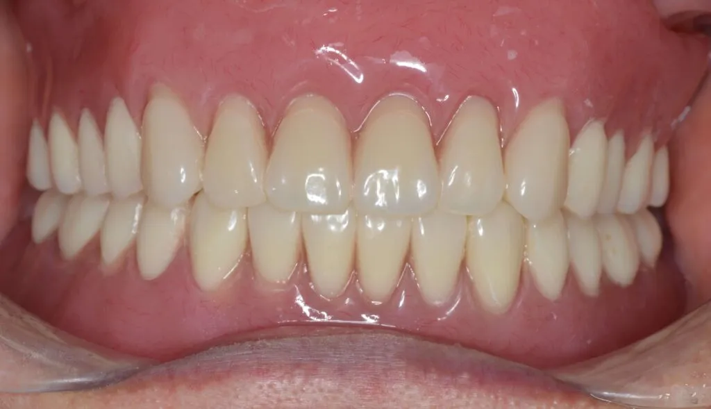 インプラントで支える入れ歯