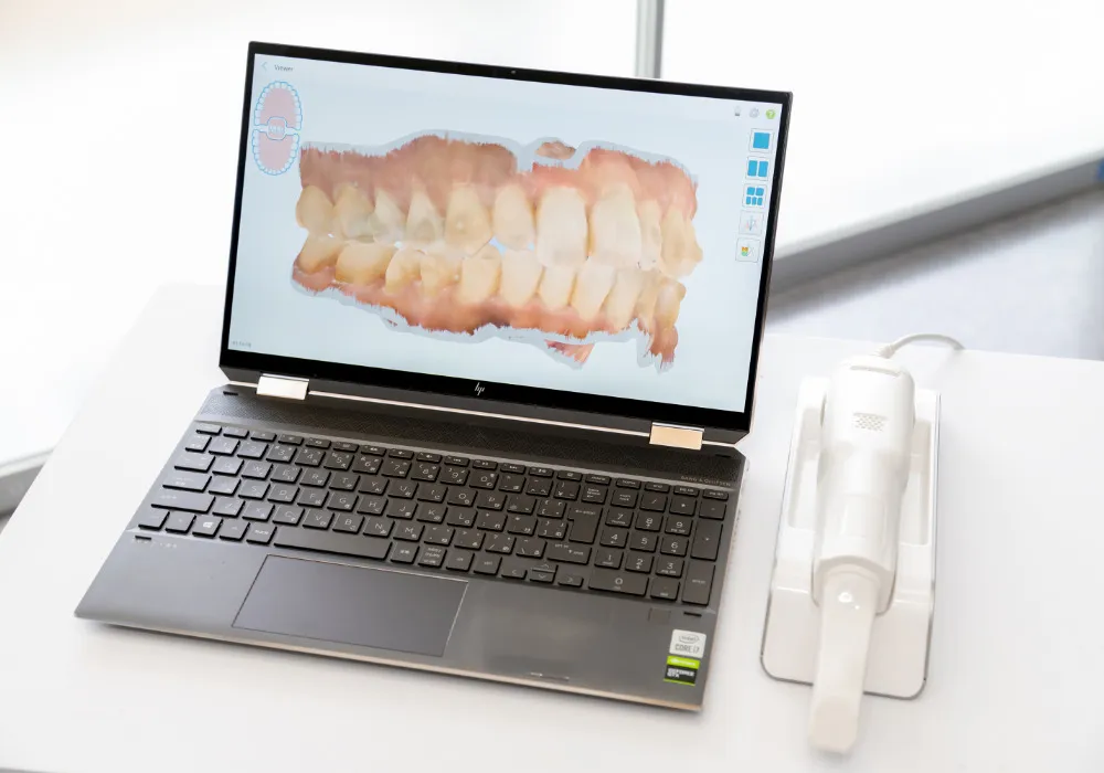 シミュレーションで、治療後の歯並びを確認