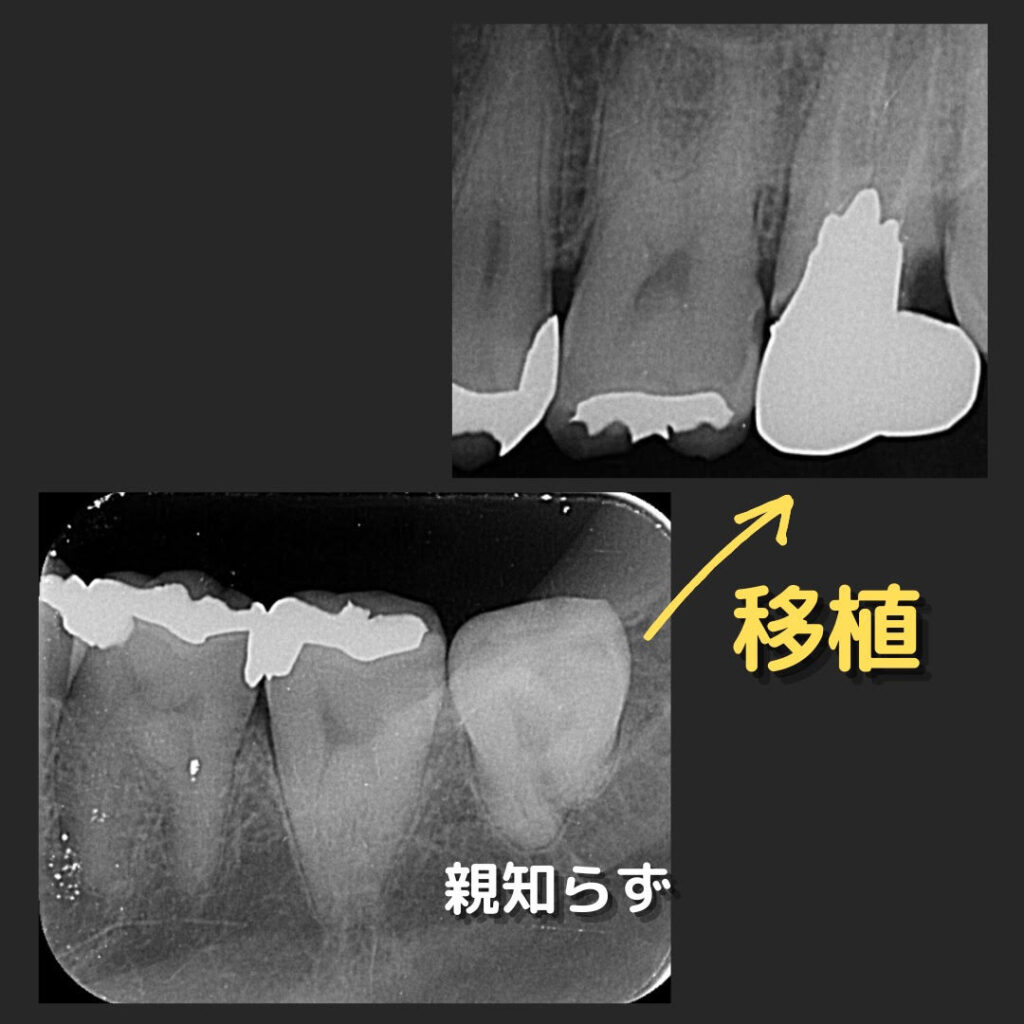 歯周外科症例②