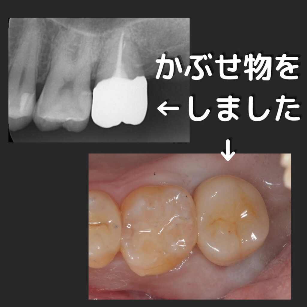 歯周外科症例④