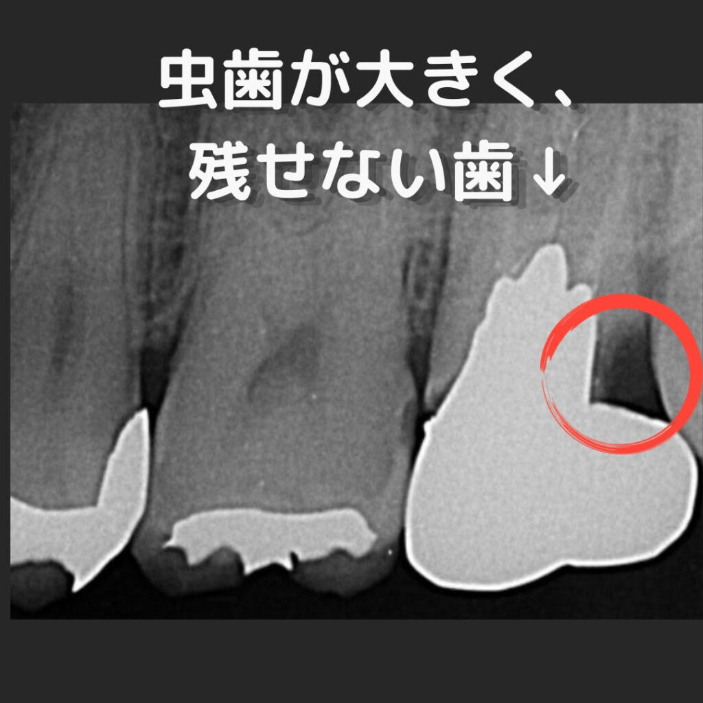 歯周外科症例①