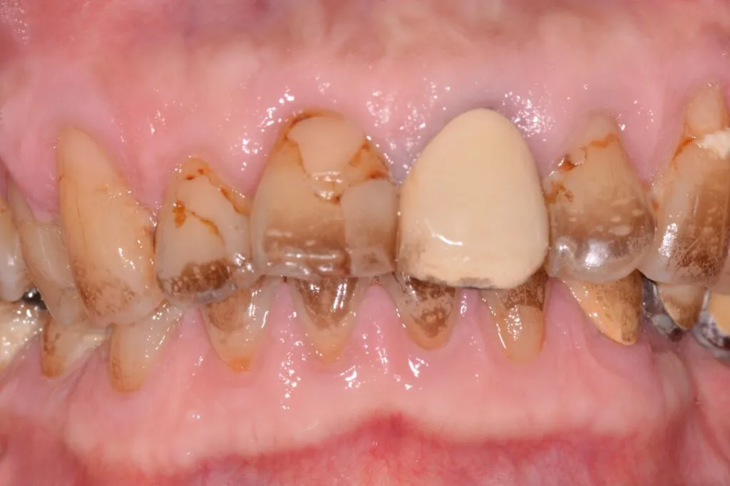 e-maxクラウン①