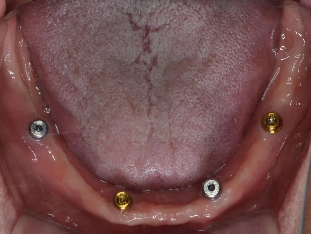 インプラントで支える入れ歯