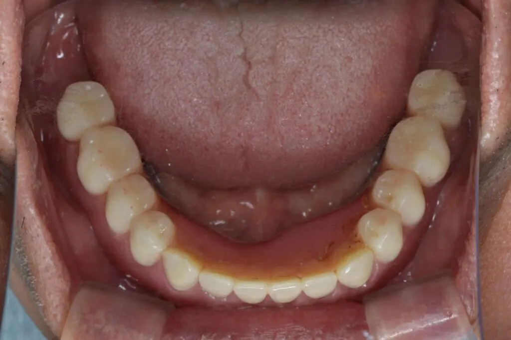 インプラントで支える入れ歯