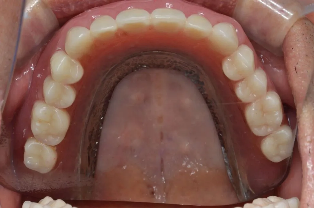 インプラントで支える入れ歯